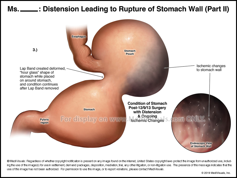figure3b-distention-leading-to-rupture-r31408-07xa-07xb-2