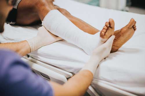 Leg in cast after an accident happened