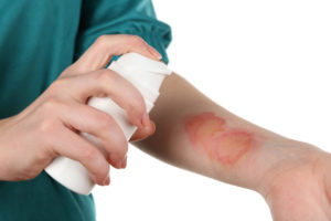 burn injuries stemming from defective products