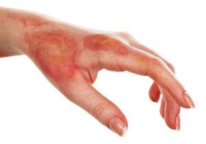 Burn Injury Attorney Aiding Those in NY | Maggiano, DiGirolamo & Lizzi P.C. burn injury attorney aiding those in ny