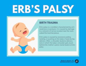 Symptoms of Erb’s Palsy in Babies do you know the symptoms of erbs palsy in babies