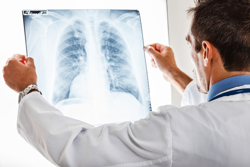 A male doctor in a white coat holding an X-ray image of human lungs up to a light source.