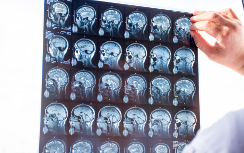 Examination of the brain with MRI. Doctor in emergency order scans fresh snapshot of patients brain MRI using x-ray view box and holding with hand, for hematoma, tumor, trauma or traumatic violations