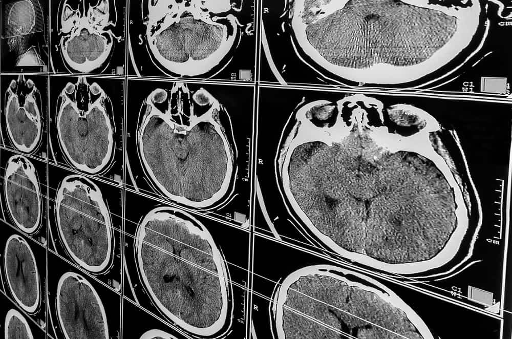 CT scan film showing multiple axial images of the brain